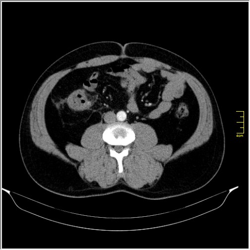 Acute right sided diverticulitis (Radiopaedia 65249-74268 Axial C+ portal venous phase 43).JPG