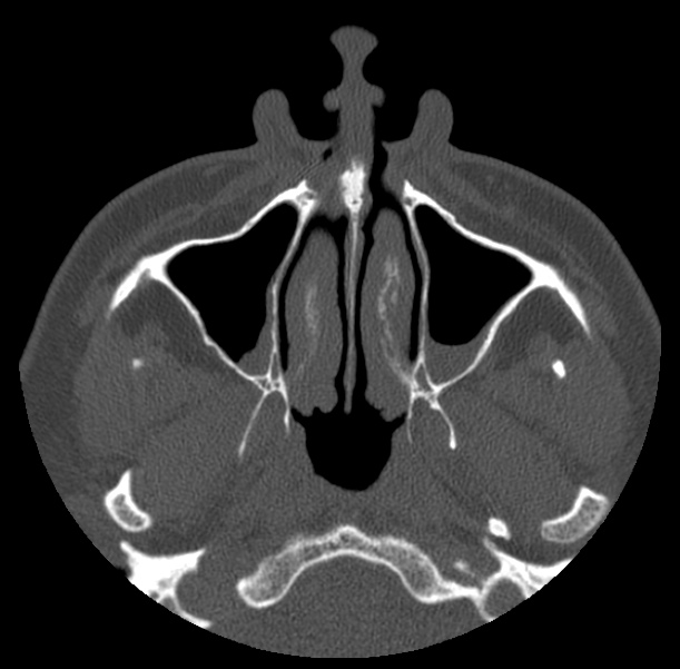 Acute sinusitis (Radiopaedia 23161-23215 Axial bone window 17).jpg