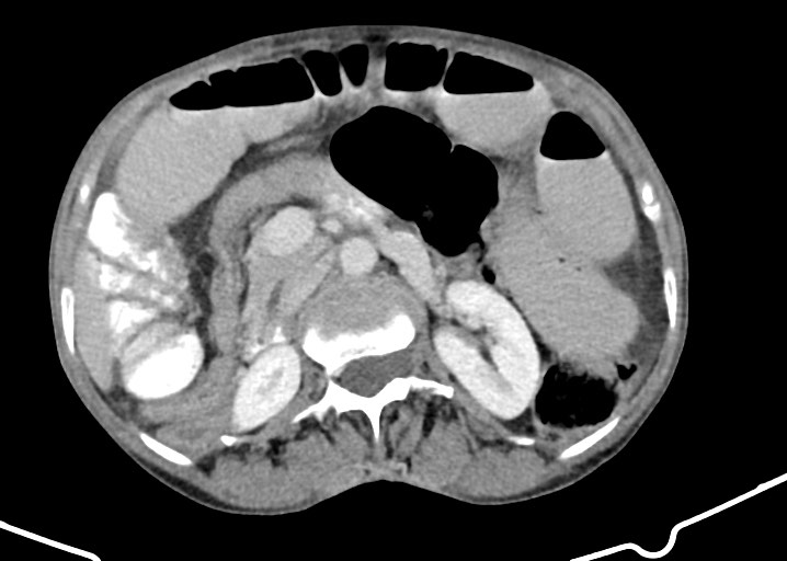 File:Acute small bowel (ileal) volvulus (Radiopaedia 71740-82139 Axial C+ portal venous phase 87).jpg