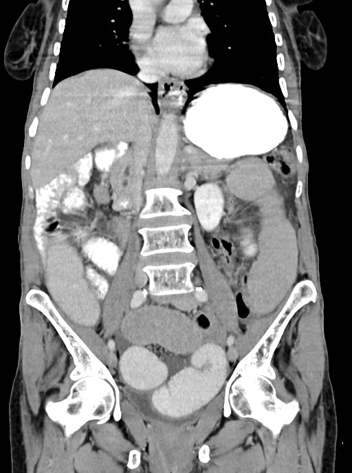 Acute small bowel (ileal) volvulus (Radiopaedia 71740-82139 Coronal C+ portal venous phase 60).jpg