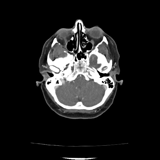 Acute subarachnoid hemorrhage and accessory anterior cerebral artery (Radiopaedia 69231-79009 Axial C+ arterial phase 81).jpg