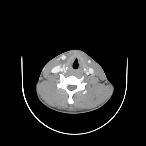 File:Acute submandibular sialadenitis secondary to ductal stone (Radiopaedia 27999-28267 Axial C+ delayed 33).jpg
