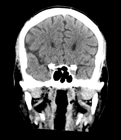 Acute superior cerebellar artery territory infarct (Radiopaedia 84104-99359 Coronal non-contrast 41).jpg