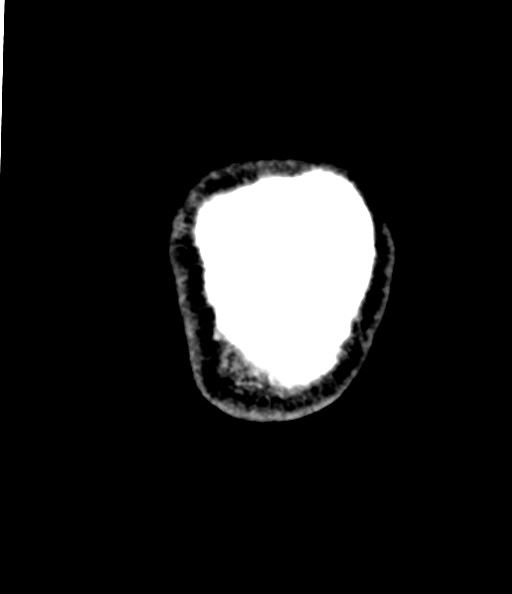 Acute superior cerebellar artery territory infarct (Radiopaedia 84104-99359 Coronal non-contrast 85).jpg