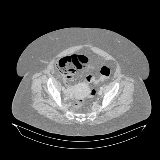 Acute superior mesenteric artery occlusion (Radiopaedia 51288-56960 Axial lung window 63).jpg