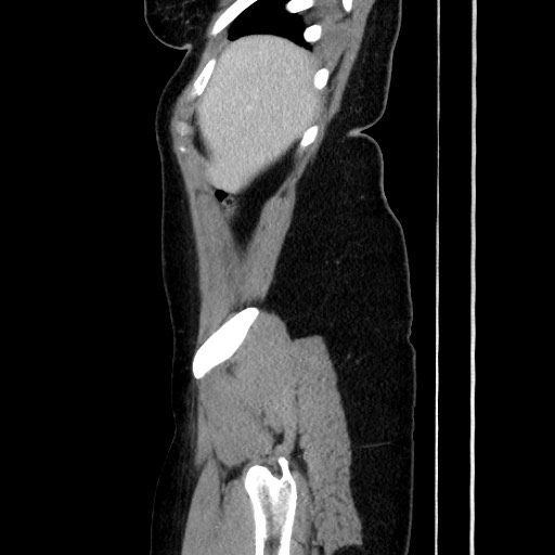 File:Acute uncomplicated appendicitis (Radiopaedia 73704-84499 Sagittal C+ portal venous phase 54).jpg