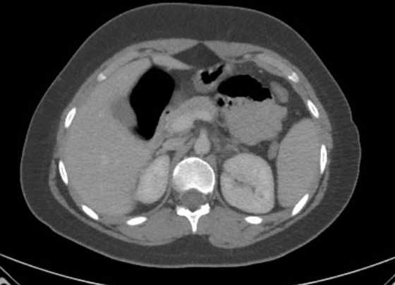 Acute unilateral nonhemorrhagic adrenal infarction (Radiopaedia 67560-76957 Axial renal parenchymal phase 45).jpg