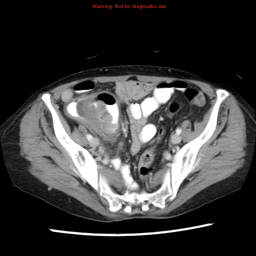 File:Adenocarcinoma of the colon (Radiopaedia 8191-9039 Axial liver window 60).jpg