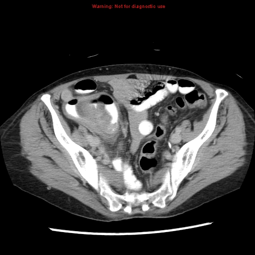 Adenocarcinoma of the colon (Radiopaedia 8191-9039 Axial renal excretory phase 46).jpg