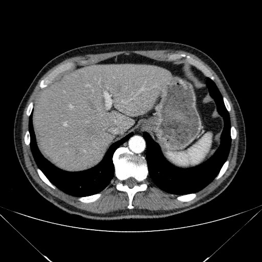 File:Adenocarcinoma of the lung (Radiopaedia 59871-67325 Axial C+ arterial phase 84).jpg