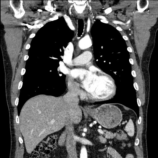 Adenocarcinoma of the lung (Radiopaedia 59871-67325 Coronal C+ arterial phase 32).jpg