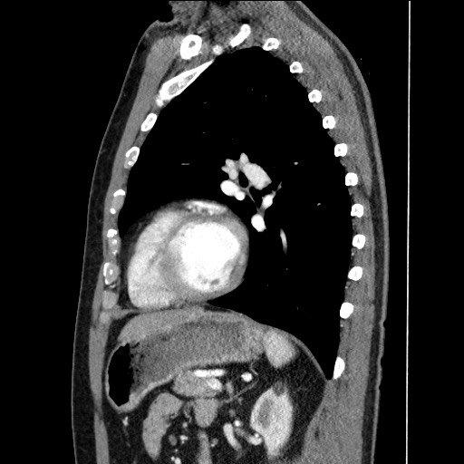 Adenocarcinoma of the lung (Radiopaedia 59871-67325 Sagittal C+ arterial phase 68).jpg