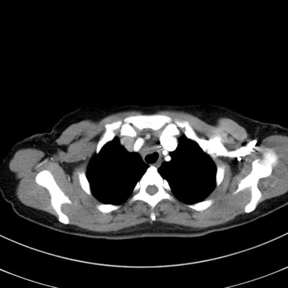 File:Adenocystic carcinoma of the trachea (Radiopaedia 47677-52525 Axial C+ arterial phase 34).jpg