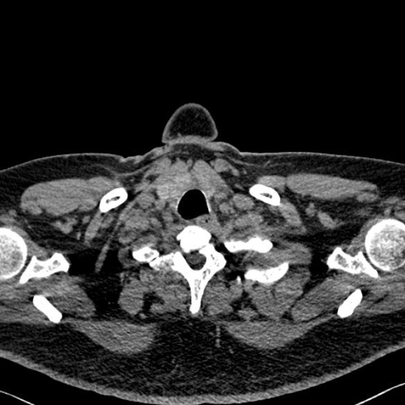 Adenoid cystic carcinoma of the trachea (Radiopaedia 49042-54137 Axial non-contrast 10).jpg