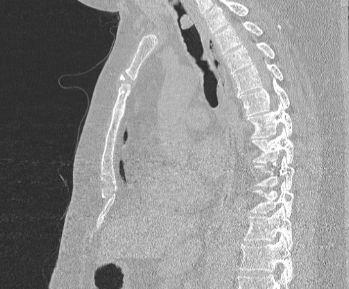 File:Adenoid cystic carcinoma of the trachea (Radiopaedia 49042-54137 Sagittal lung window 248).jpg