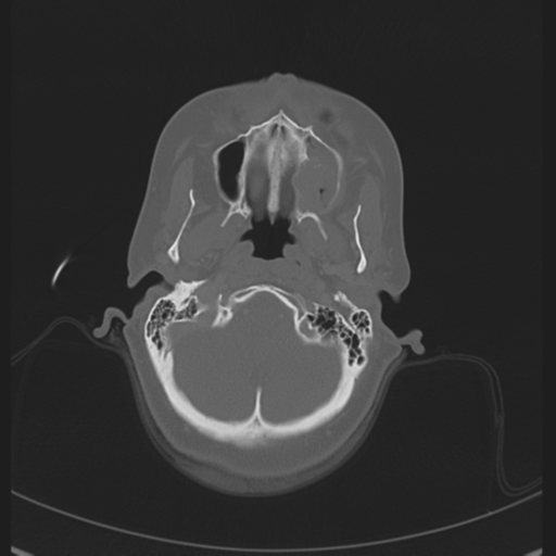 Adenoid cystic tumor of palate (Radiopaedia 46980-51518 Coronal bone window 1).png
