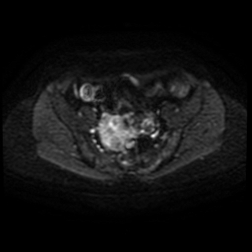Adenoma malignum of cervix (Radiopaedia 66441-75705 Axial DWI 30).jpg