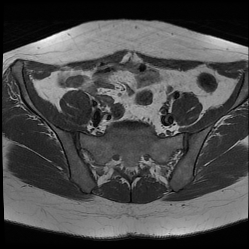 File:Adenomyosis-scar endometriosis (Radiopaedia 65863-75022 Axial T1 7).jpg