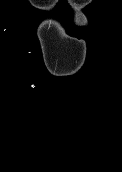Adhesional small bowel obstruction (Radiopaedia 48397-53305 Coronal C+ portal venous phase 8).jpg