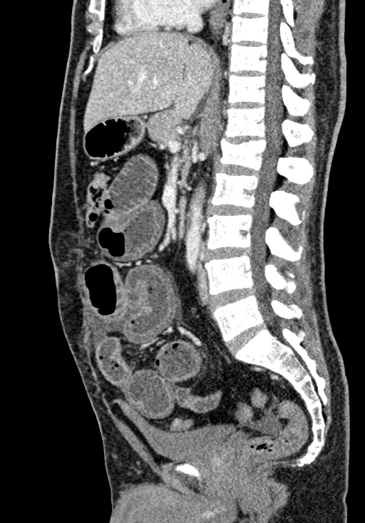Adhesional small bowel obstruction (Radiopaedia 58900-66131 Sagittal C+ portal venous phase 126).jpg