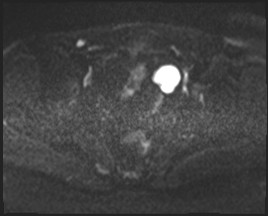 Adnexal multilocular cyst (O-RADS US 3- O-RADS MRI 3) (Radiopaedia 87426-103754 Axial DWI 45).jpg