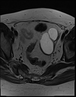 File:Adnexal multilocular cyst (O-RADS US 3- O-RADS MRI 3) (Radiopaedia 87426-103754 Axial T2 13).jpg