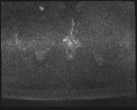 File:Adnexal multilocular cyst (O-RADS US 3. O-RADS MRI 3) (Radiopaedia 87426-103754 Axial 100).jpeg