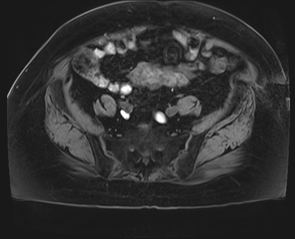 Adrenal cortical carcinoma (Radiopaedia 64017-72770 Axial T1 C+ fat sat 72).jpg