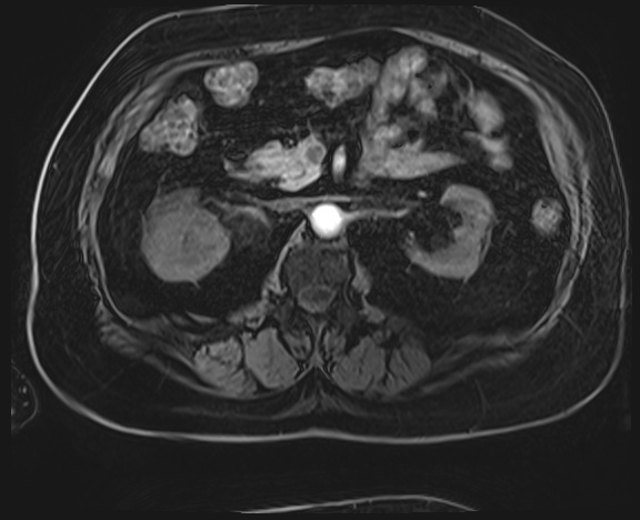 Adrenal cortical carcinoma (Radiopaedia 64017-72770 H 21).jpg