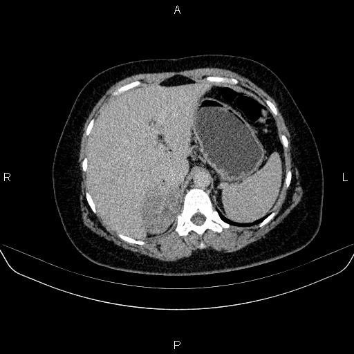 Adrenal cortical carcinoma (Radiopaedia 84882-100379 Axial C+ delayed 17).jpg