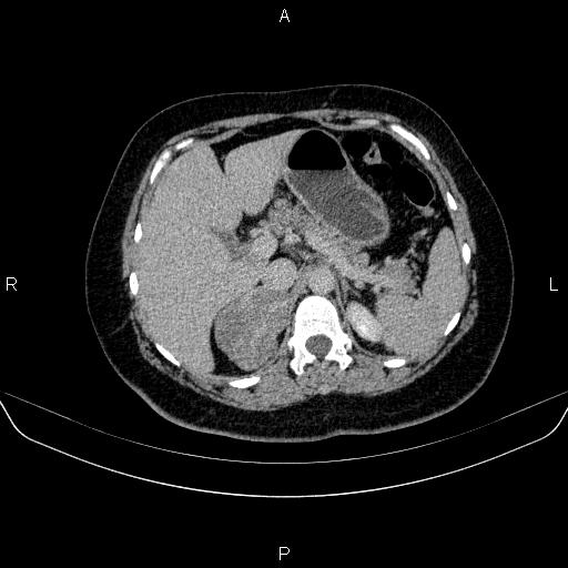 Adrenal cortical carcinoma (Radiopaedia 84882-100379 Axial C+ delayed 23).jpg