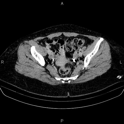 Adrenal cortical carcinoma (Radiopaedia 84882-100379 Axial C+ delayed 82).jpg