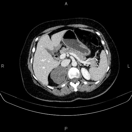 File:Adrenal cortical carcinoma (Radiopaedia 84882-100379 Axial C+ portal venous phase 27).jpg