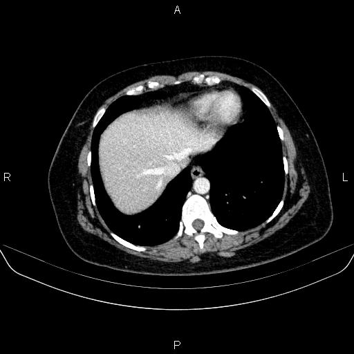 File:Adrenal cortical carcinoma (Radiopaedia 84882-100379 Axial C+ portal venous phase 9).jpg