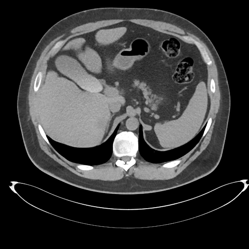 Adrenal cyst (Radiopaedia 45625-49778 Axial non-contrast 24).png