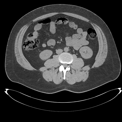File:Adrenal cyst (Radiopaedia 45625-49778 Axial non-contrast 66).png