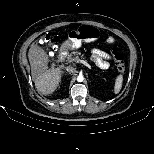 Adrenal hemorrhage (Radiopaedia 62622-70916 Axial C+ arterial phase 135).jpg
