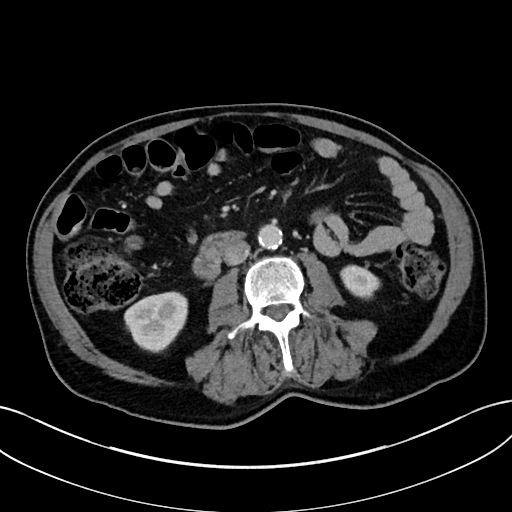 File:Adrenal lymphoma (Radiopaedia 73730-84529 Axial C+ portal venous phase 63).jpg