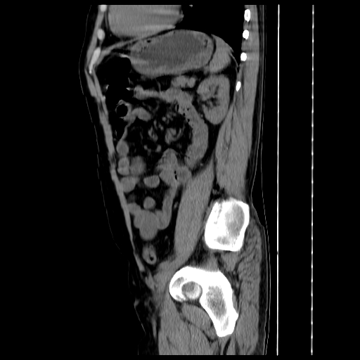 File:Adrenal myelolipoma (Radiopaedia 41843-44834 Sagittal non-contrast 30).jpg