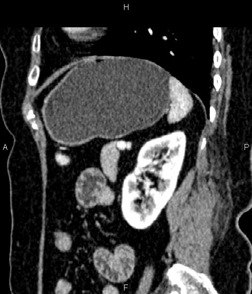 File:Adrenal myelolipoma (Radiopaedia 82742-96986 Sagittal renal cortical phase 77).jpg