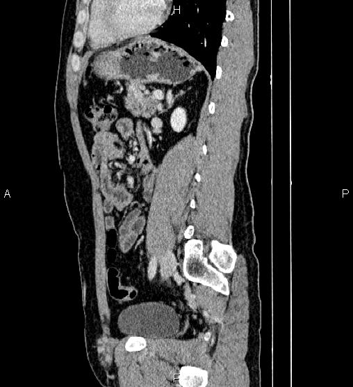Adrenal myelolipoma (Radiopaedia 87794-104246 Sagittal renal cortical phase 61).jpg