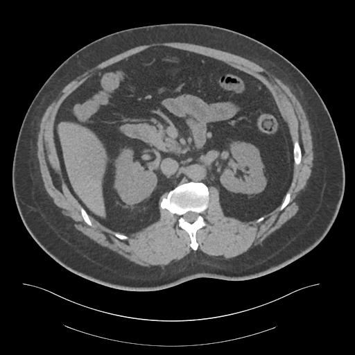 File:Adrenal vein sampling and adrenal nodular hyperplasia - Conn syndrome (Radiopaedia 30561-31337 Axial non-contrast 34).jpg
