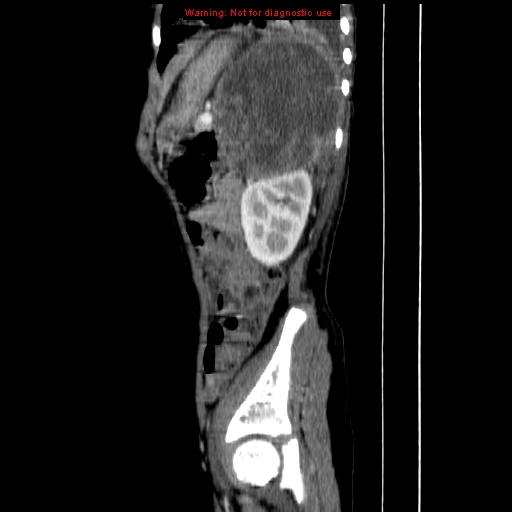 File:Adrenocortical carcinoma (Radiopaedia 9449-10131 Sagittal C+ portal venous phase 15).jpg