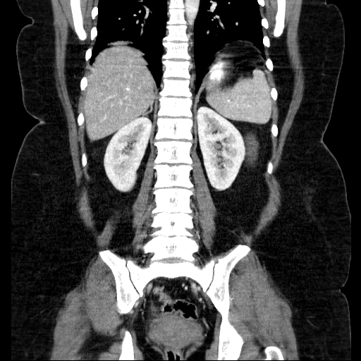 File:Afferent loop syndrome - secondary to incarcerated trocar site hernia (Radiopaedia 82959-97305 Coronal C+ portal venous phase 104).jpg