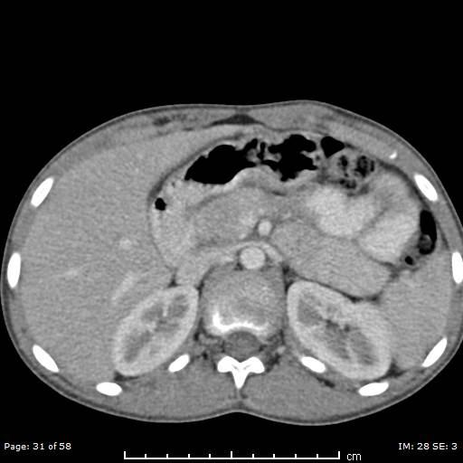 Agenesis of the gallbladder (Radiopaedia 55454-61905 B 31).jpg