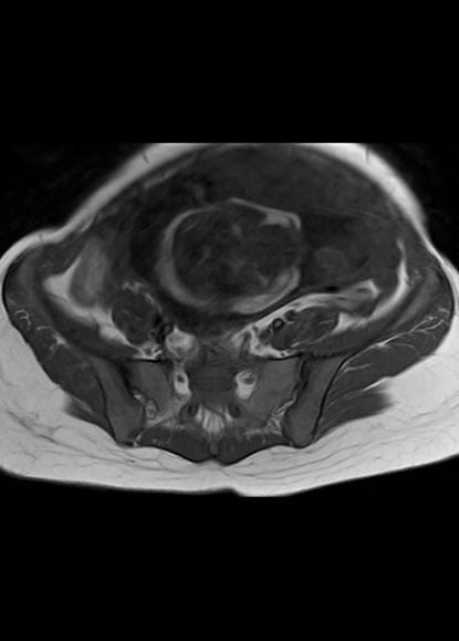 File:Aggressive angiomyxoma of the pelvis and perineum (Radiopaedia 59162-66479 T1 23).jpg