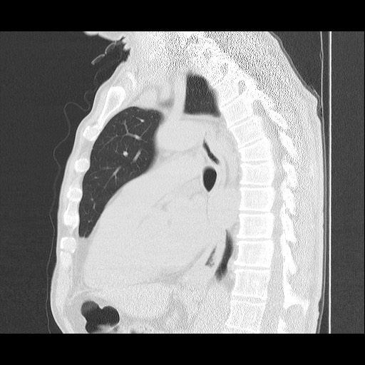 Allergic bronchopulmonary aspergillosis (ABPA) (Radiopaedia 60594-68313 Sagittal lung window 27).jpg