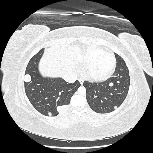 Alveolar soft part sarcoma - right leg (Radiopaedia 59432-67091 Axial lung window 86).jpg