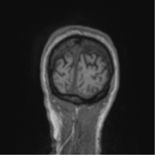 File:Alzheimer's disease- with apraxia (Radiopaedia 54763-61011 Coronal T1 11).png