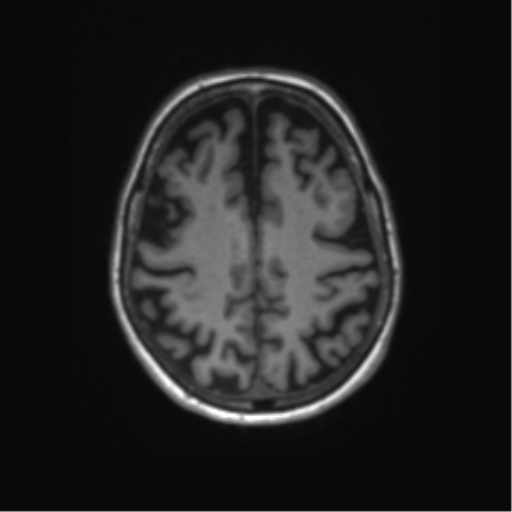 File:Alzheimer's disease (Radiopaedia 42658-45802 Axial T1 47).png